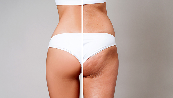 Gegen Cellulite